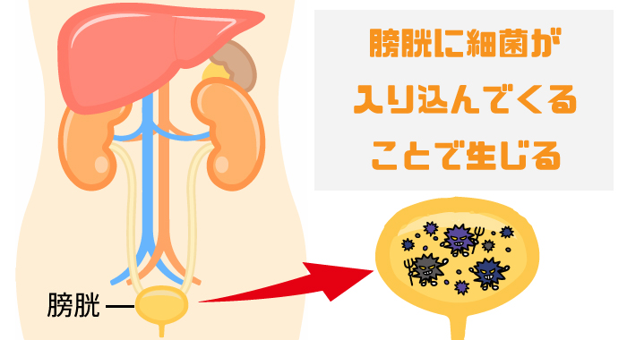 膀胱炎の仕組み